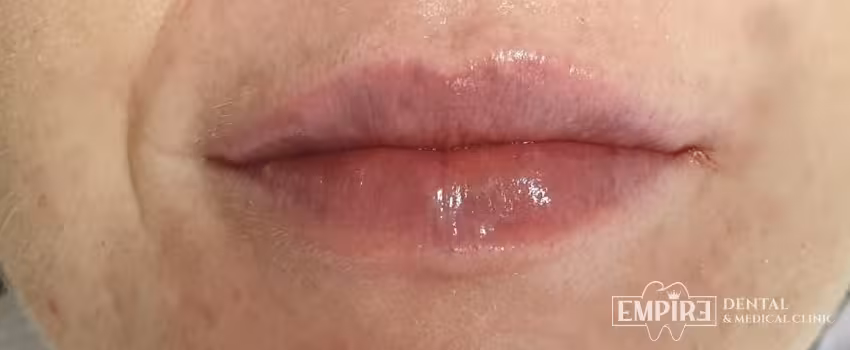 After non-surgical facial aesthetics result at Empire Clinic Dublin 1 — case 14