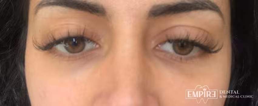 After non-surgical facial aesthetics result at Empire Clinic Dublin 1 — case 15