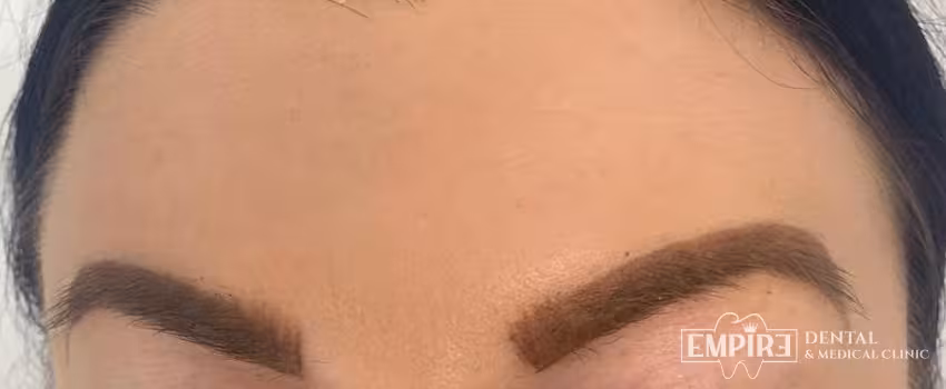 After non-surgical facial aesthetics result at Empire Clinic Dublin 1 — case 16