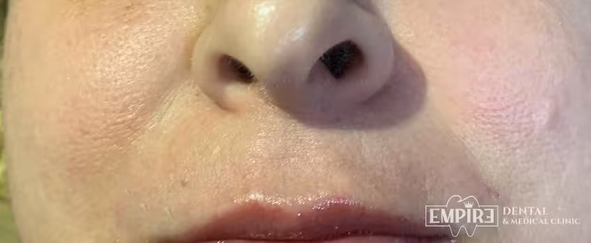 After non-surgical facial aesthetics result at Empire Clinic Dublin 1 — case 17