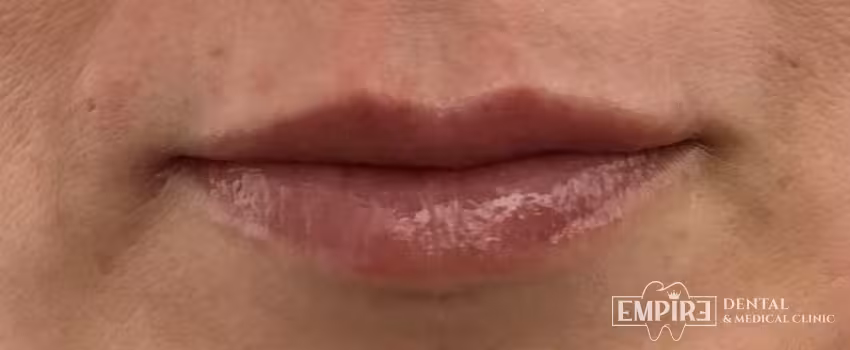 After non-surgical facial aesthetics result at Empire Clinic Dublin 1 — case 18