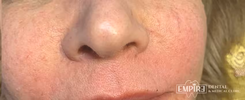 After non-surgical facial aesthetics result at Empire Clinic Dublin 1 — case 19