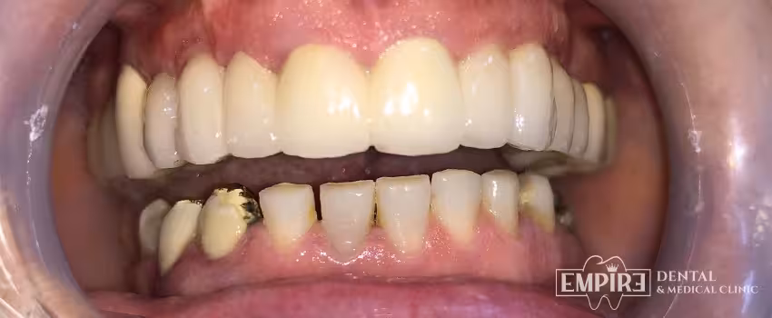 After dental treatment result at Empire Dental Clinic Dublin 1 — case 21