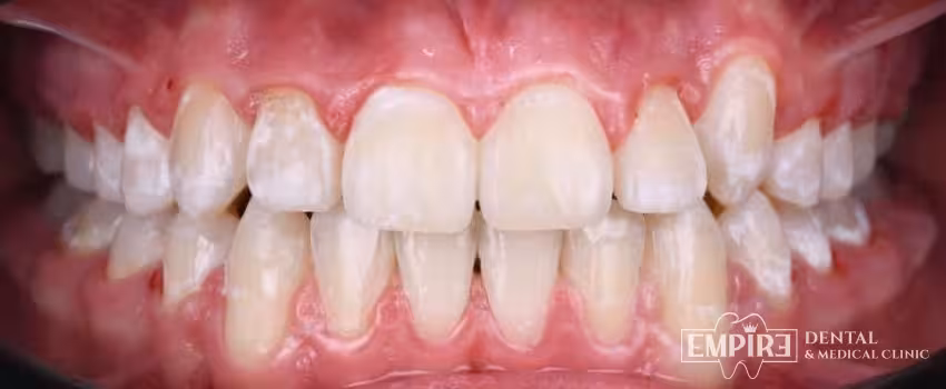 Before dental treatment at Empire Dental Clinic Dublin 1 — case 24