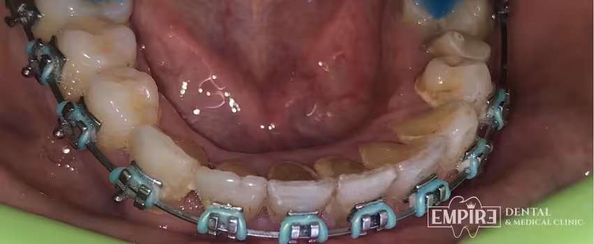 Before dental treatment at Empire Dental Clinic Dublin 1 — case 23