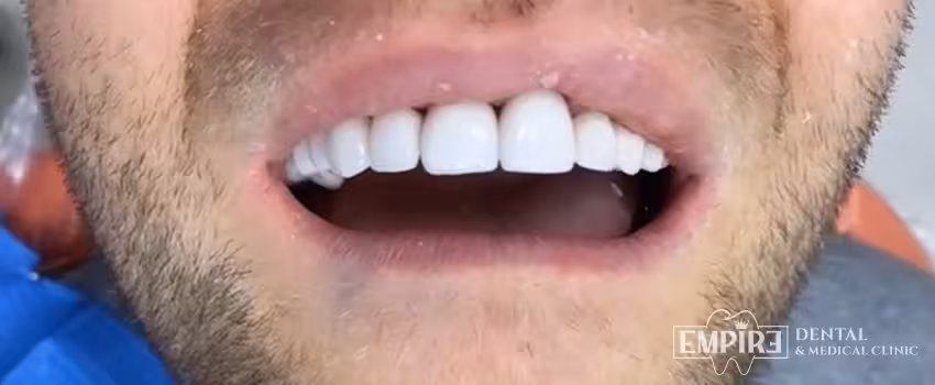 After dental treatment result at Empire Dental Clinic Dublin 1 — case 22