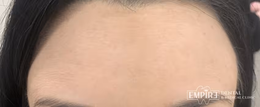 After non-surgical facial aesthetics result at Empire Clinic Dublin 1 — case 29