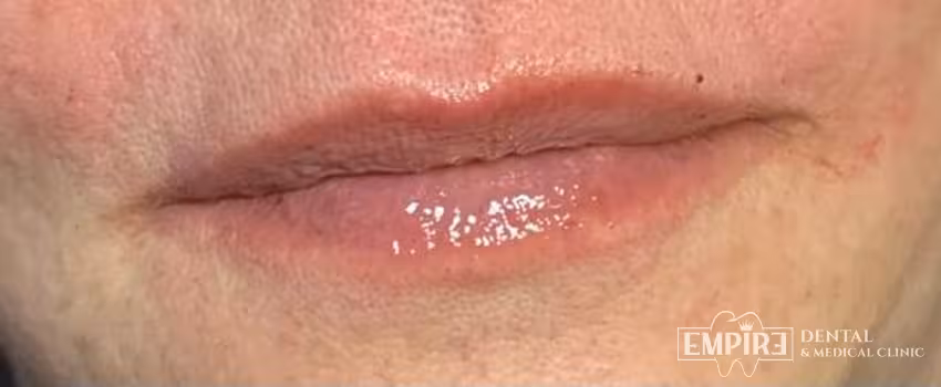 After non-surgical facial aesthetics result at Empire Clinic Dublin 1 — case 28