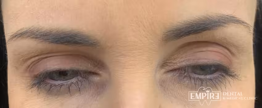 After non-surgical facial aesthetics result at Empire Clinic Dublin 1 — case 27