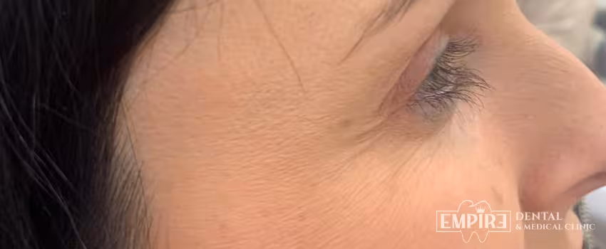 After non-surgical facial aesthetics result at Empire Clinic Dublin 1 — case 26