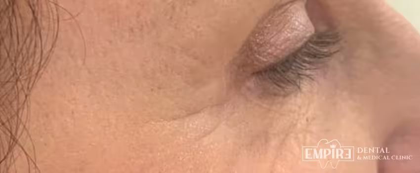 After non-surgical facial aesthetics result at Empire Clinic Dublin 1 — case 25