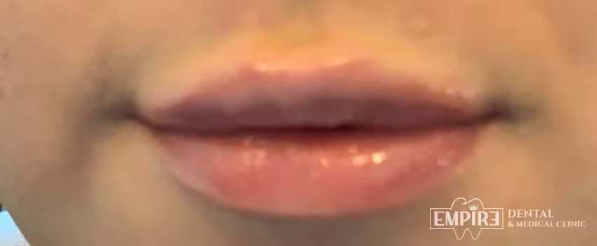 After non-surgical facial aesthetics result at Empire Clinic Dublin 1 — case 24