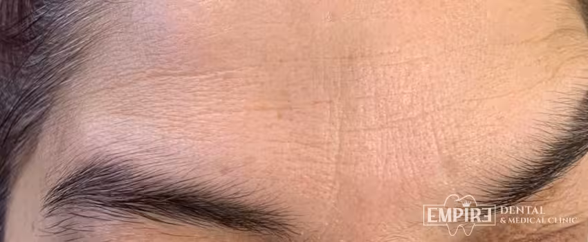 After non-surgical facial aesthetics result at Empire Clinic Dublin 1 — case 23