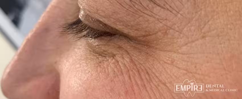 After non-surgical facial aesthetics result at Empire Clinic Dublin 1 — case 22