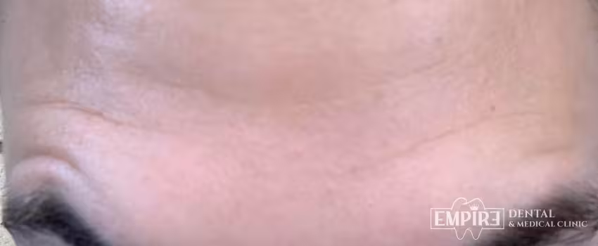 After non-surgical facial aesthetics result at Empire Clinic Dublin 1 — case 20