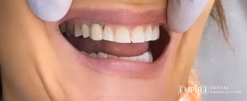 After dental treatment result at Empire Dental Clinic Dublin 1 — case 27
