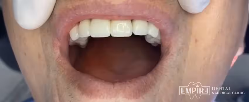 After dental treatment result at Empire Dental Clinic Dublin 1 — case 28