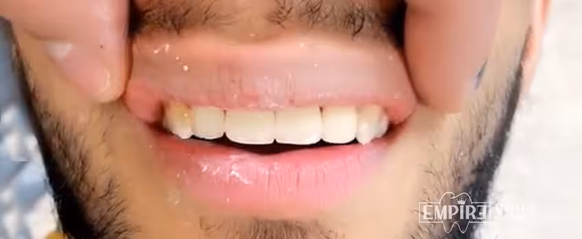 After dental treatment result at Empire Dental Clinic Dublin 1 — case 26