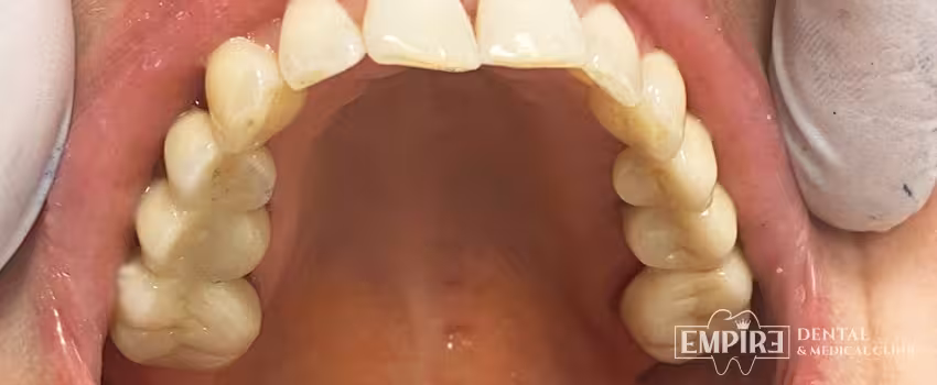 After dental treatment result at Empire Dental Clinic Dublin 1 — case 25