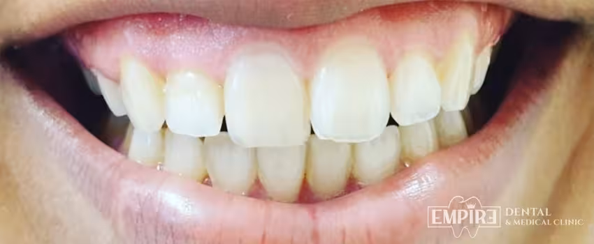 Before non-surgical facial aesthetics at Empire Clinic Dublin 1 — case 1