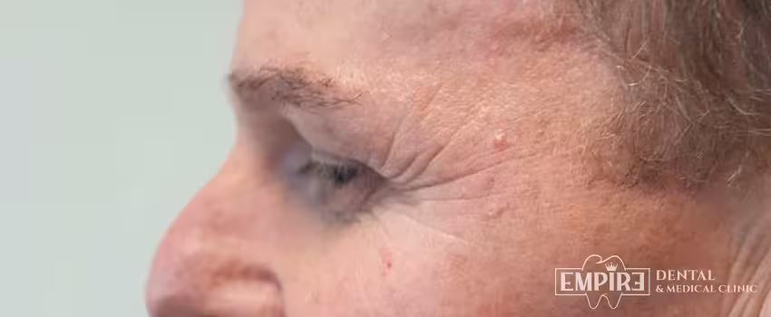 Before non-surgical facial aesthetics at Empire Clinic Dublin 1 — case 3