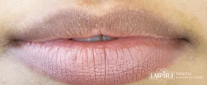 Before non-surgical facial aesthetics at Empire Clinic Dublin 1 — case 2