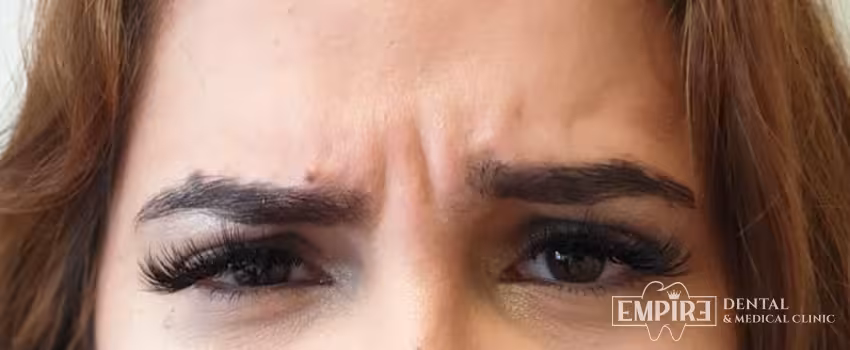 Before non-surgical facial aesthetics at Empire Clinic Dublin 1 — case 4