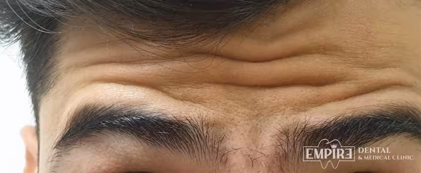 Before non-surgical facial aesthetics at Empire Clinic Dublin 1 — case 6