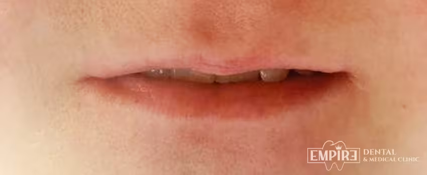 Before non-surgical facial aesthetics at Empire Clinic Dublin 1 — case 7