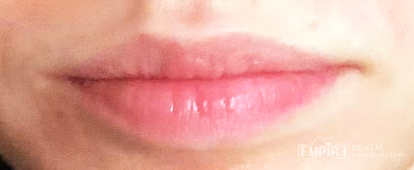 Before non-surgical facial aesthetics at Empire Clinic Dublin 1 — case 8