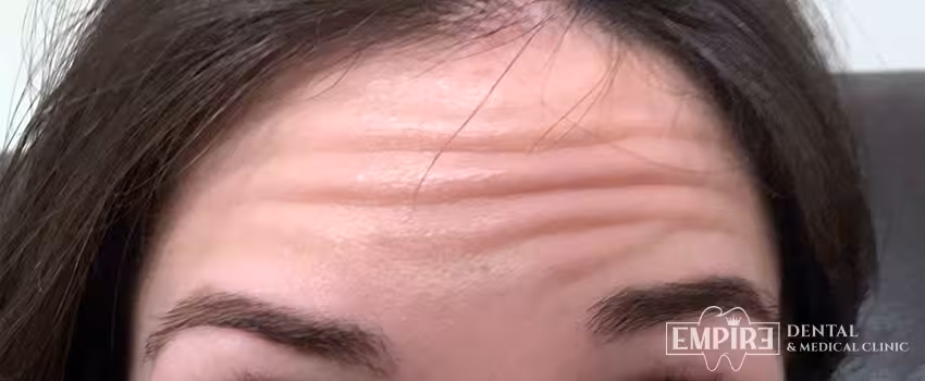 Before non-surgical facial aesthetics at Empire Clinic Dublin 1 — case 9