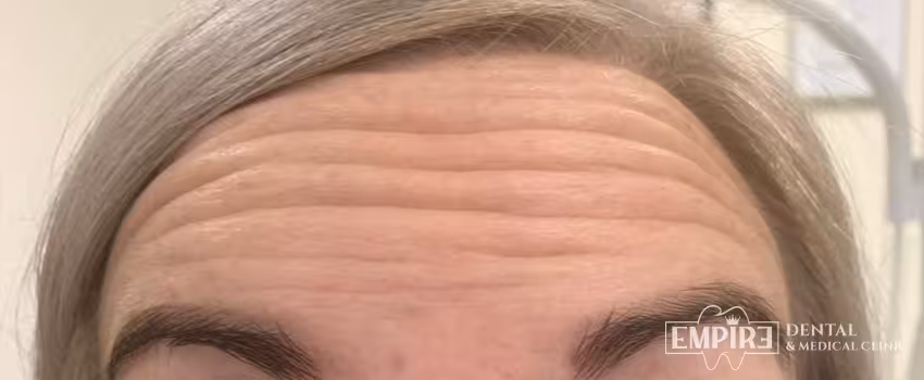 Before non-surgical facial aesthetics at Empire Clinic Dublin 1 — case 10