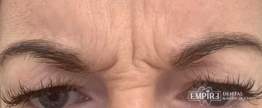 Before non-surgical facial aesthetics at Empire Clinic Dublin 1 — case 12