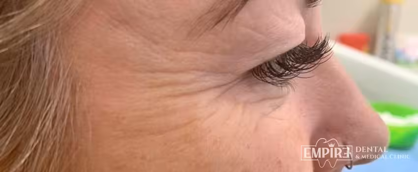 Before non-surgical facial aesthetics at Empire Clinic Dublin 1 — case 5