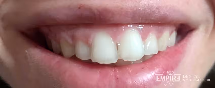 Before non-surgical facial aesthetics at Empire Clinic Dublin 1 — case 13