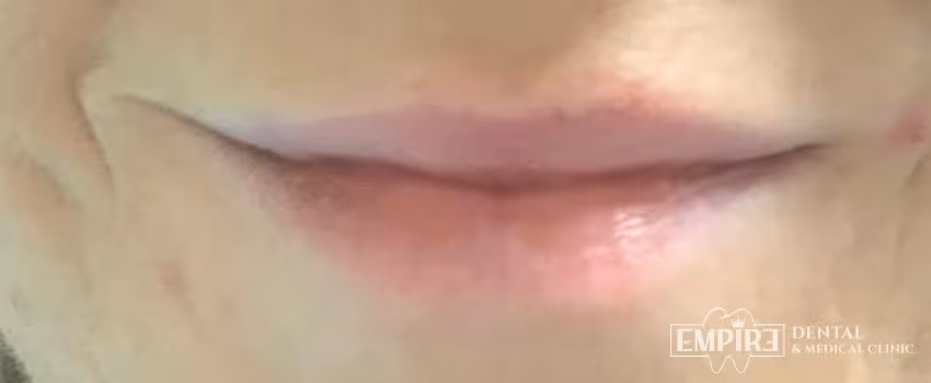 Before non-surgical facial aesthetics at Empire Clinic Dublin 1 — case 14