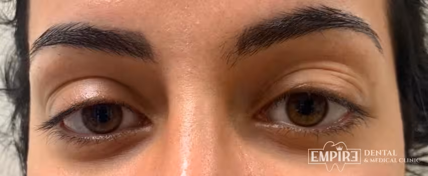 Before non-surgical facial aesthetics at Empire Clinic Dublin 1 — case 15