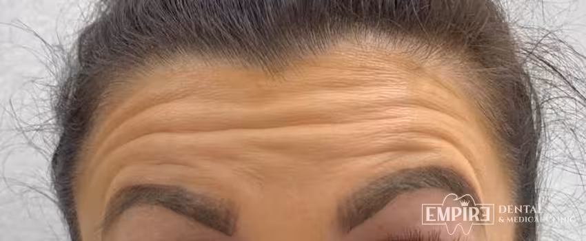 Before non-surgical facial aesthetics at Empire Clinic Dublin 1 — case 16