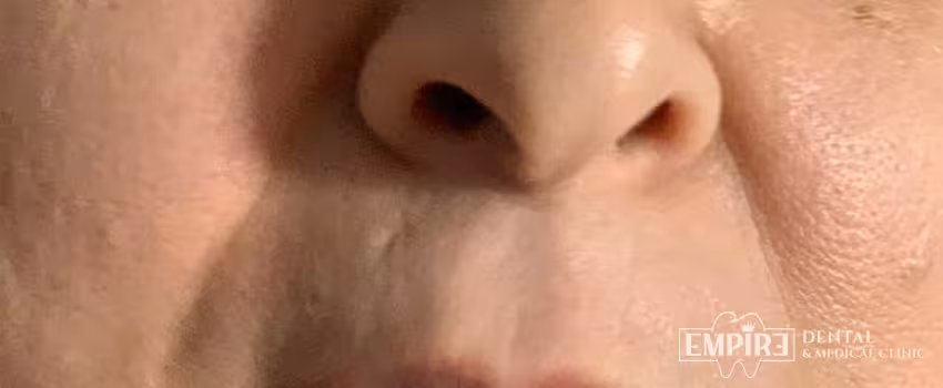 Before non-surgical facial aesthetics at Empire Clinic Dublin 1 — case 17