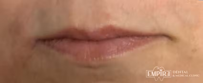 Before non-surgical facial aesthetics at Empire Clinic Dublin 1 — case 18