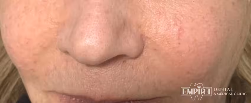 Before non-surgical facial aesthetics at Empire Clinic Dublin 1 — case 19