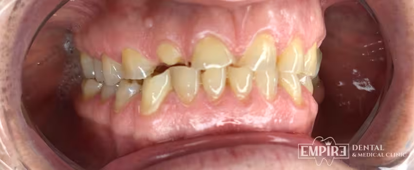 Before dental treatment at Empire Dental Clinic Dublin 1 — case 21