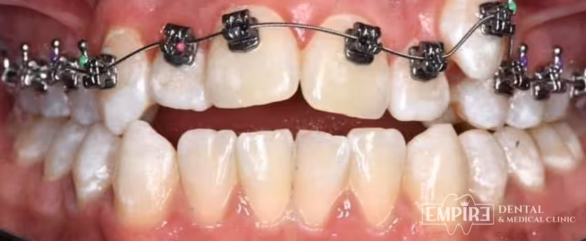 After dental treatment result at Empire Dental Clinic Dublin 1 — case 24