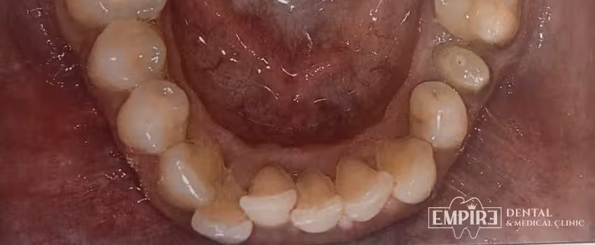 After dental treatment result at Empire Dental Clinic Dublin 1 — case 23