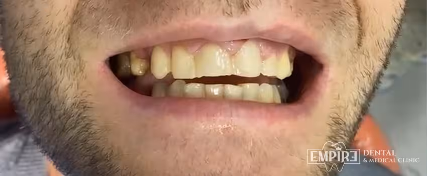 Before dental treatment at Empire Dental Clinic Dublin 1 — case 22