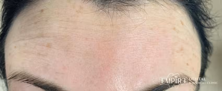 Before non-surgical facial aesthetics at Empire Clinic Dublin 1 — case 29