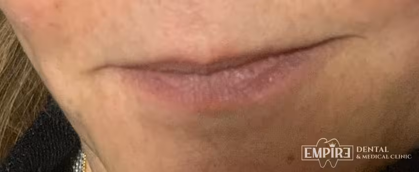 Before non-surgical facial aesthetics at Empire Clinic Dublin 1 — case 28