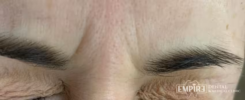 Before non-surgical facial aesthetics at Empire Clinic Dublin 1 — case 27