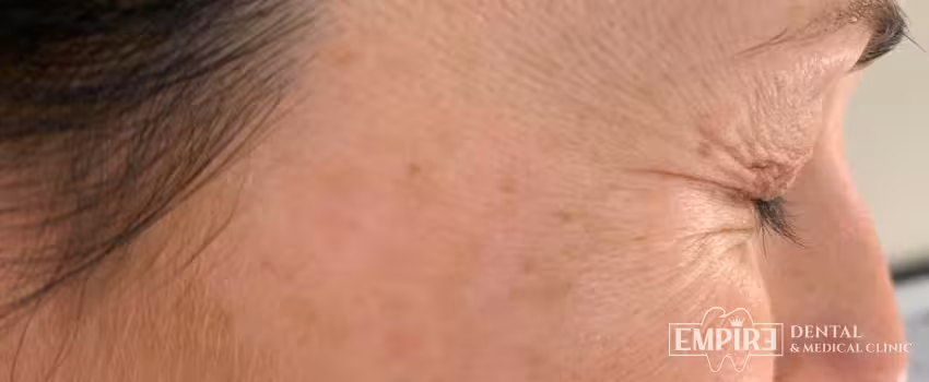 Before non-surgical facial aesthetics at Empire Clinic Dublin 1 — case 26