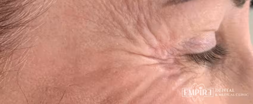 Before non-surgical facial aesthetics at Empire Clinic Dublin 1 — case 25